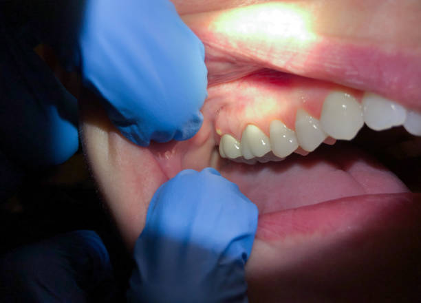 Best Emergency Treatment for Toothache in Cajahs Mountain, NC